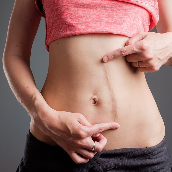 European woman with long abdominal scars after operation standing on black color